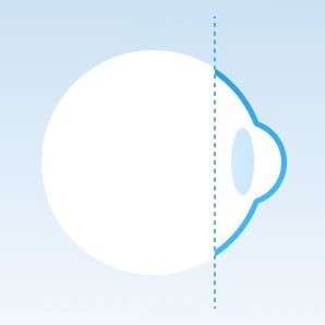 Eye without lens